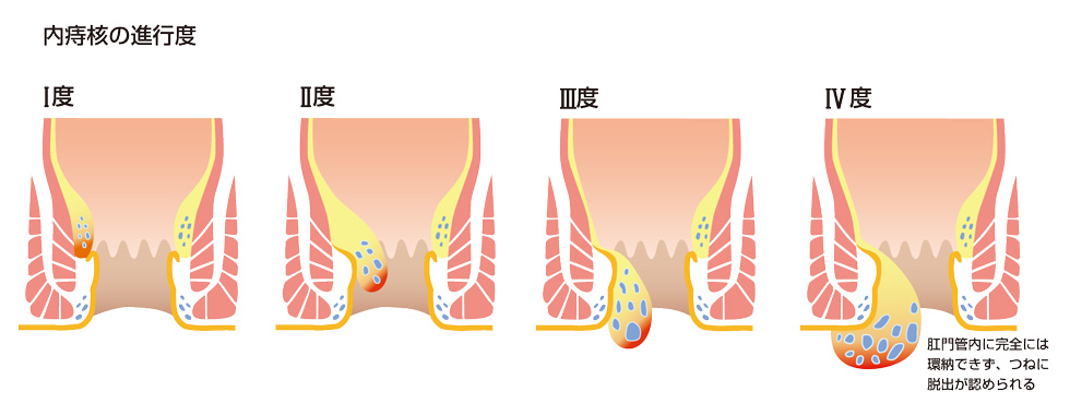 内痔核の進行度
