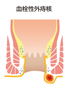 血栓外外痔核