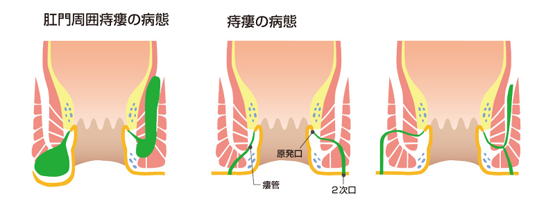 校門周囲痔瘻の病態