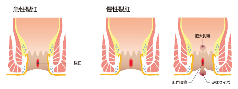 急性裂肛と慢性裂肛